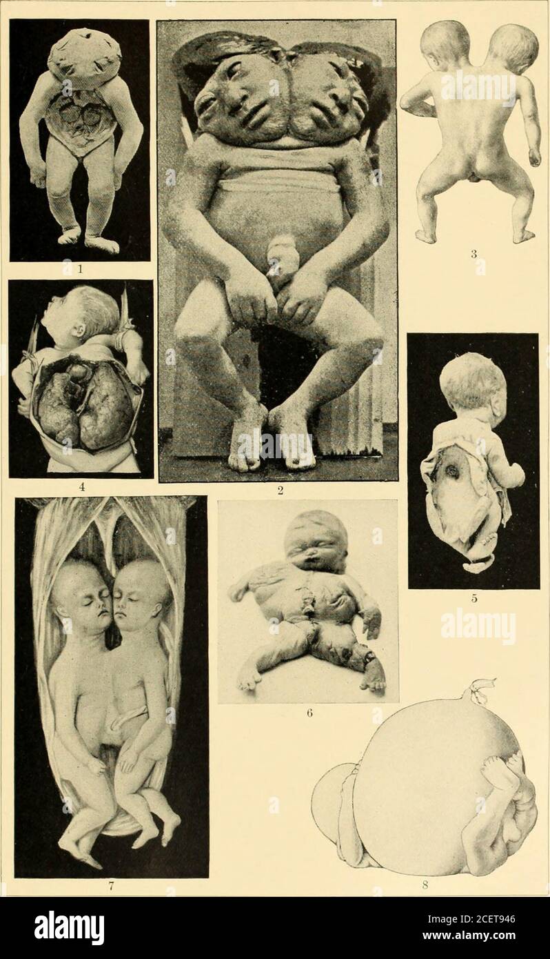 . An American text-book of obstetrics. For practitioners and students. Fig. 366.—Dipygus (Wells). Fig. 367.—Dipygus parasiticus. diameter of 9 centimeters. The increase in size of successive children mustbe borne in mind in cases of contracted pelvis. The first two or three infants DYSTOCIA. Plat*: 37.. 1. Diprosopus (Hirst and Piersol). 2. Diprosopus (Fleming). 3. Dicephalus. 4. Large cystic kidneys(Fussell). 5. Largo meningocele and spina bifida i Hirst and Piersol). 6. Congenital cystic elephantiasis(Wilson). 7. Thoracopagus (Hirst and Piersol). 8. Distended bladder (Ahlfeld). DYSTOCIA. 563 Stock Photo