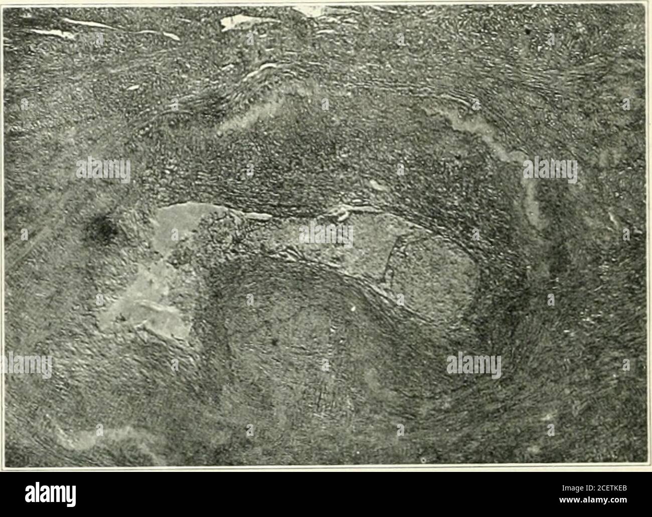 Fibrous Tissue In The Uterus High Resolution Stock Photography and ...