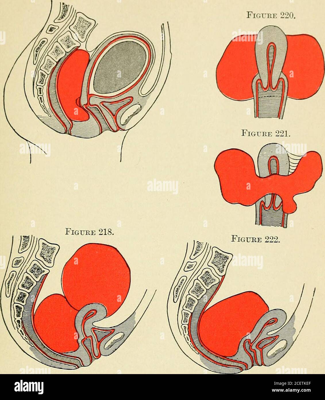 The Principles and practice of gynecology : for students and practitioners.  rine haematocele lifting the peritoneum high out of the cul-de-sac of  Douglas, and extending into both broad ligaments. Easily felt