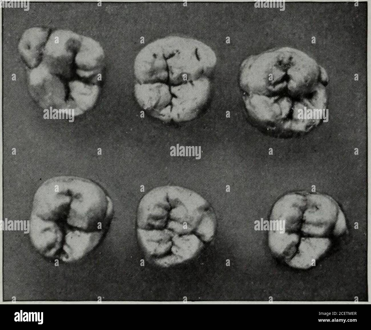 Supernumerary teeth hires stock photography and images Alamy