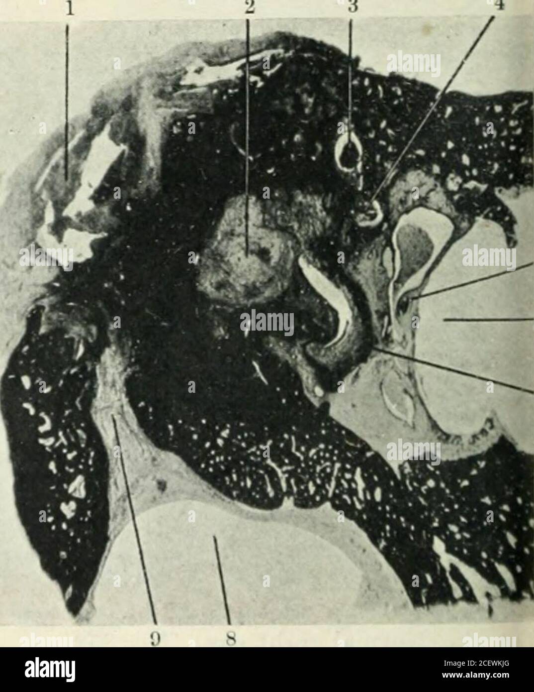 Ear canal abscess hires stock photography and images Alamy