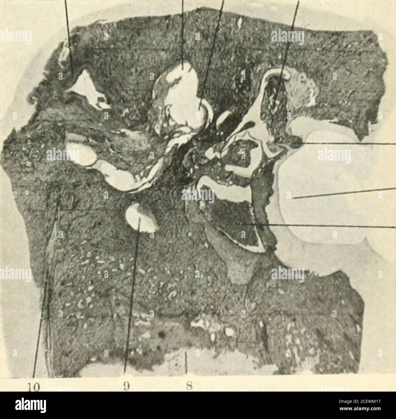 Ear canal abscess hires stock photography and images Alamy