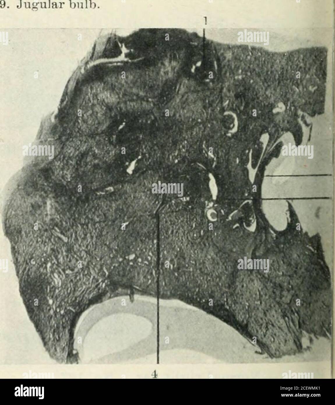 . The Journal of laryngology and otology. Fig. 3a.—Diseased left ear. No. 275. Internal meatus almost obliterated. ! Facial nerve. ! Middle coil of cochlea almost filled vrith new fibretissue. Tensor tympani., Thickened submucous tissue filling tympanum. I, External meatus. i Region of old fistula from tympanum into basal coil! Scala tympani cf basal coil filled with new bone. Jugular bulb.. Fig. 4a.—Diseased left ear. No. 295. 1. Geniculate ganglion in contact with the extradan! abscess. j 2. Tymi)anic membrane adherent to inner wall of tym pnnuin. | i. Fistula into basal coil of cochlea. , i Stock Photo