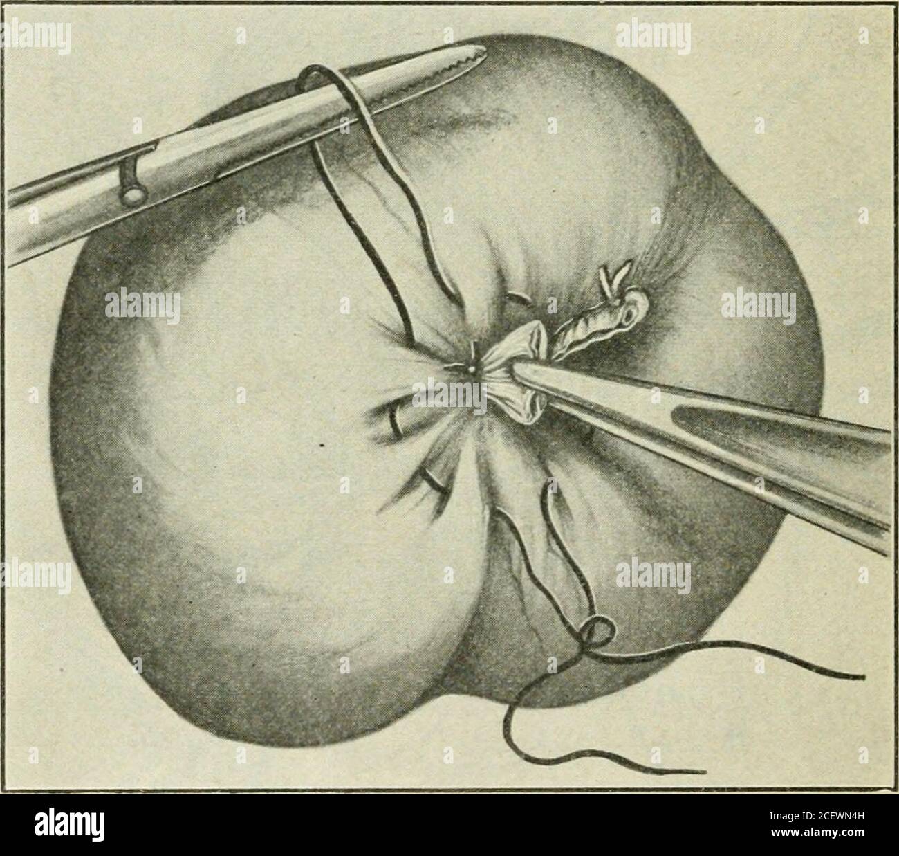 a manual of gyncology and pelvic surgery for students and practitioners fig 254the purse string suture laid the base of the appendix crushed aplain catgut ligature in position to tie around the crushed portion many methods of managing the stump have been devisedligation of the base amputation of the appendix andcauterization of the exposed mucosa being the simplest andthis may be practised with satisfaction whenever drainage must 552 diseases associated with gynecologic lesions be employed according to some good authorities the samesimple treatment is perfectly adequate in all 2CEWN4H