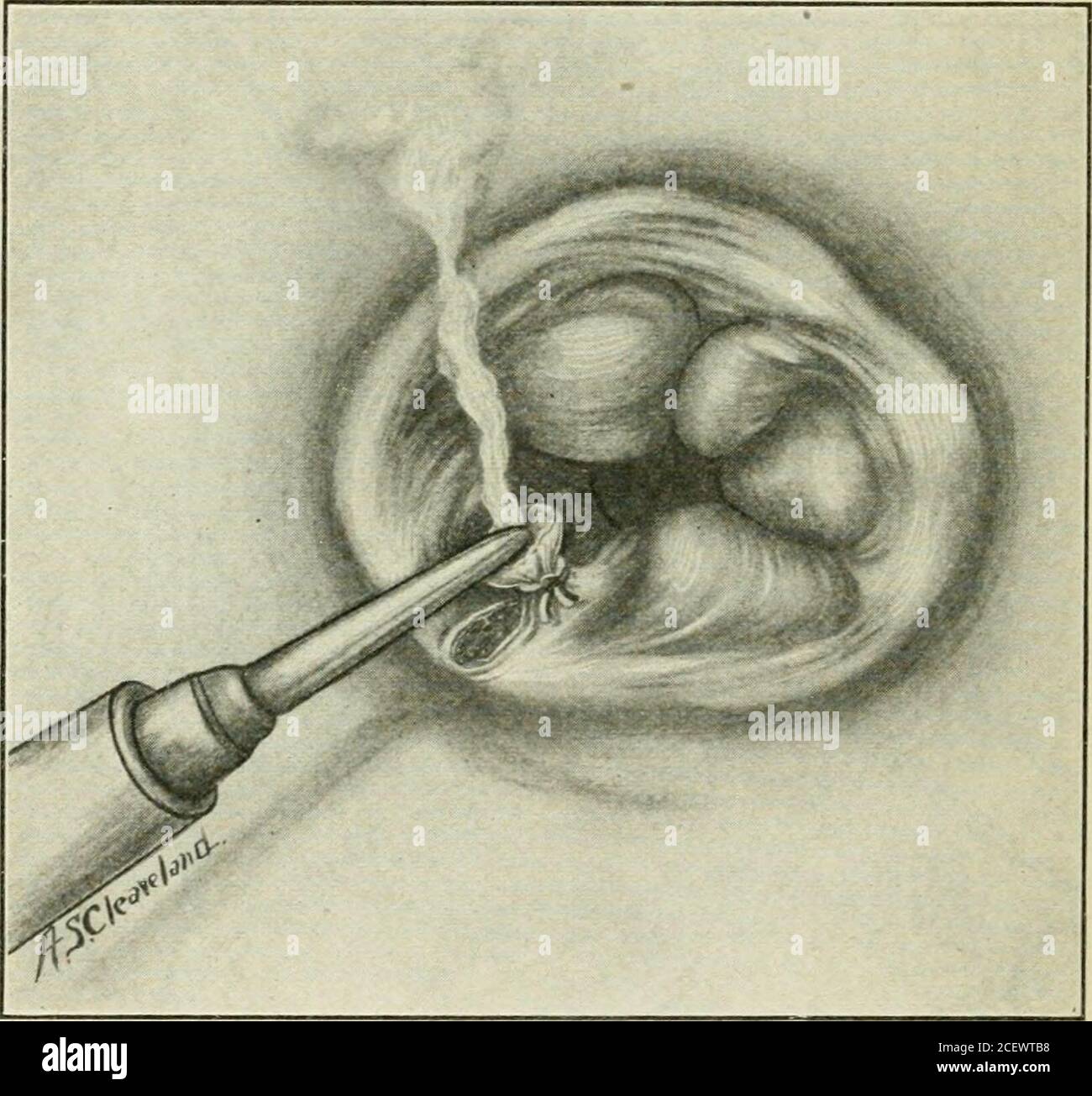 An enema with oil hires stock photography and images Alamy