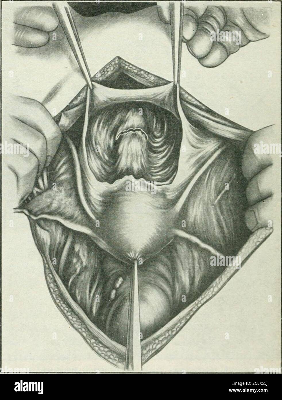 . A manual of gynæcology and pelvic surgery, for students and practitioners. Fig. 177.—Pan