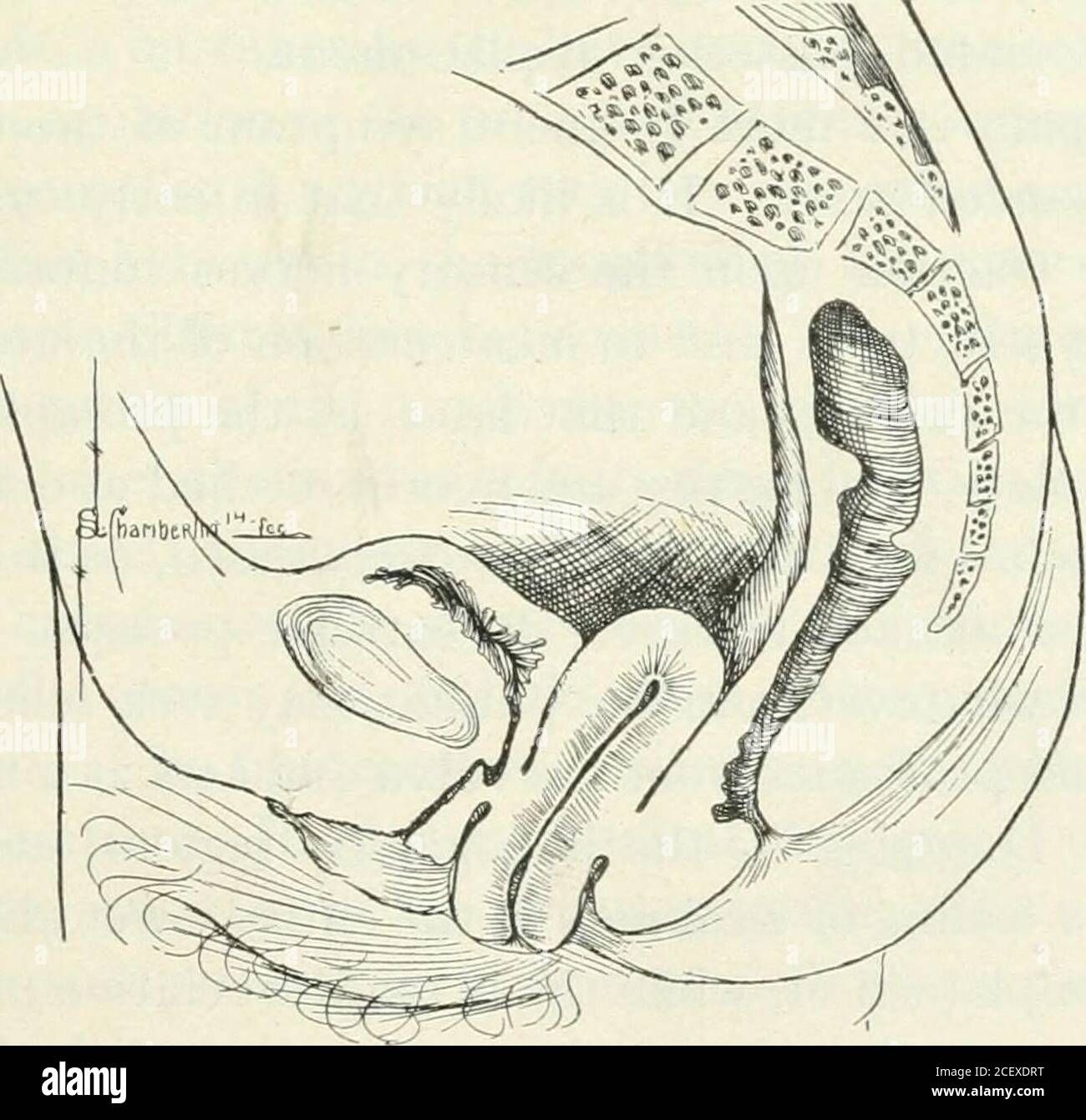  A Manual Of Gyn cology And Pelvic Surgery For Students And Practitioners Fig 115 Ascent Of 