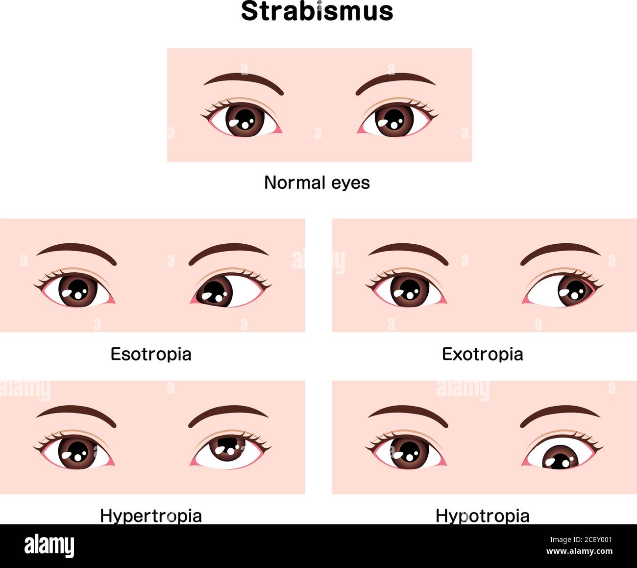Types of strabismus vector illustration Stock Vector