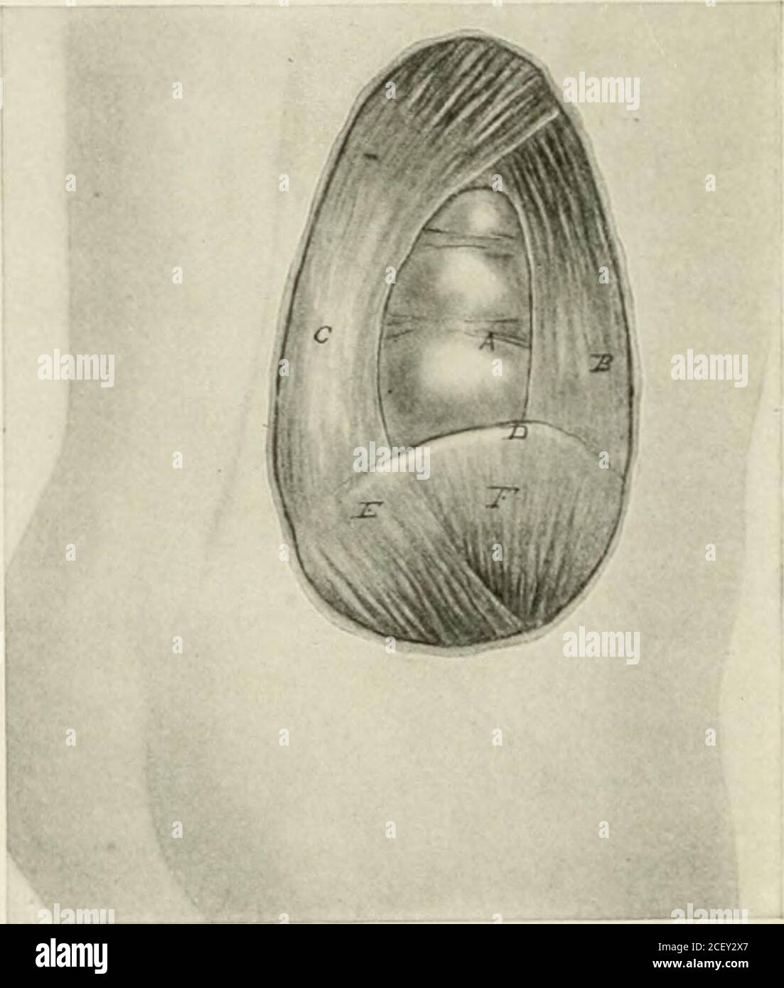 . Abdominal hernia its diagnosis and treatment. Congenital lumbar
