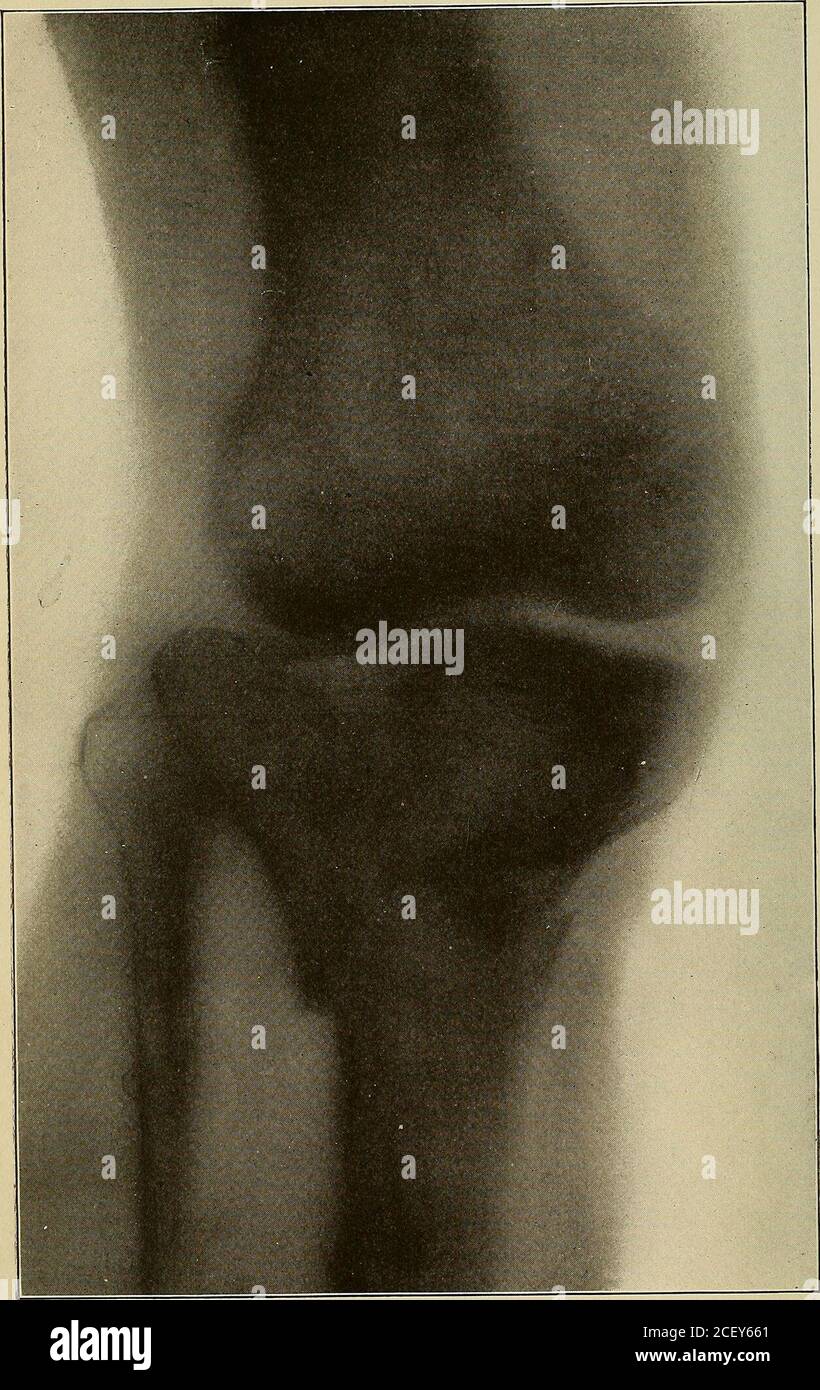 Fractures Are Flexion Extension High Resolution Stock Photography and ...