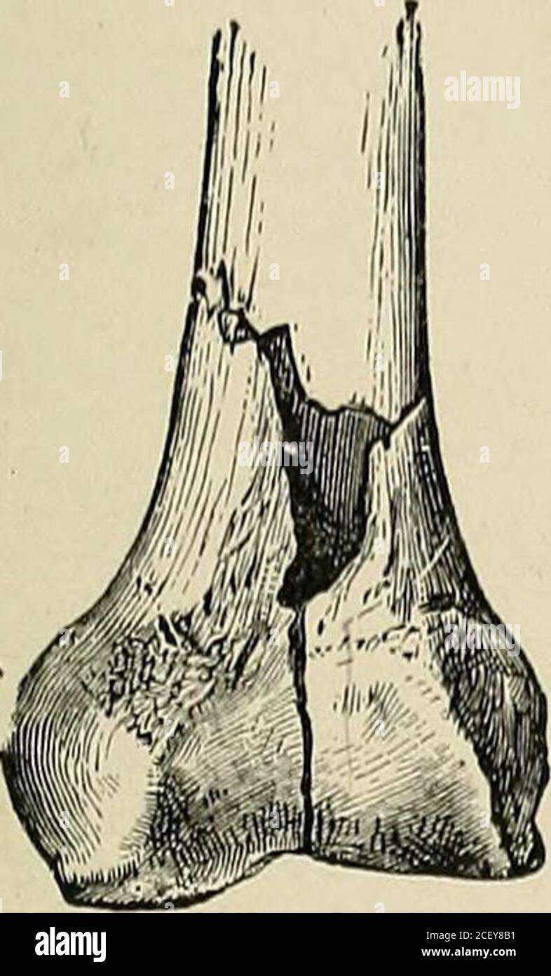 A practical treatise on fractures and dislocations . g lost its