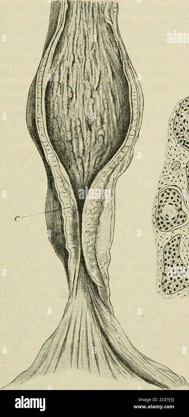 . Lehrbuch der speziellen pathologischen Anatomie für Studierende und Ärzte. ercarcinomen erwähnte Beobachtung des Verf.). Der Krebs hat am häufigsten die Tendenz, sich ringförmig auszu-breiten und Stenose zu bewirken. Seltener findet man die insulare,wandständige Form, die als ulceriertes Infiltrat oder als rundliches oderlängliches Plateau oder als Fungus vorkommt. Ein Teil der Krebse istweich, üppig wuchernd und zerfällt bald zu einem unregelmäßigen, nichtselten verjauchenden Geschwür; andere sind harte Scirrhen, zellärmer, mitstarker bindegewebiger Umwandlung. Die scirrhösen Formen sind of Stock Photo