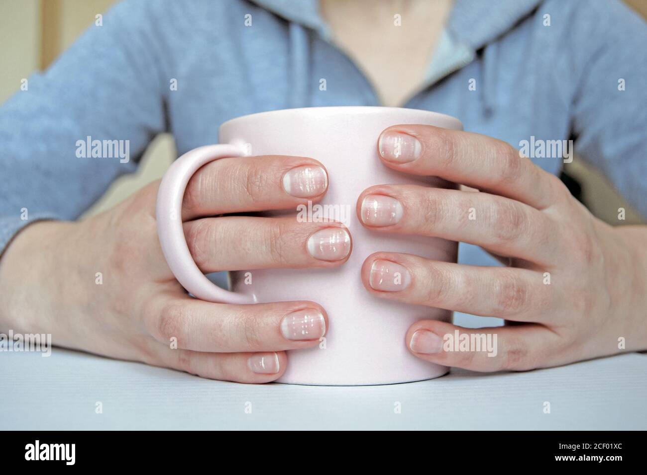 Many white spots on fingernails (Leukonychia) due to calcium deficiency or  stress. Female hands holding mug Stock Photo - Alamy