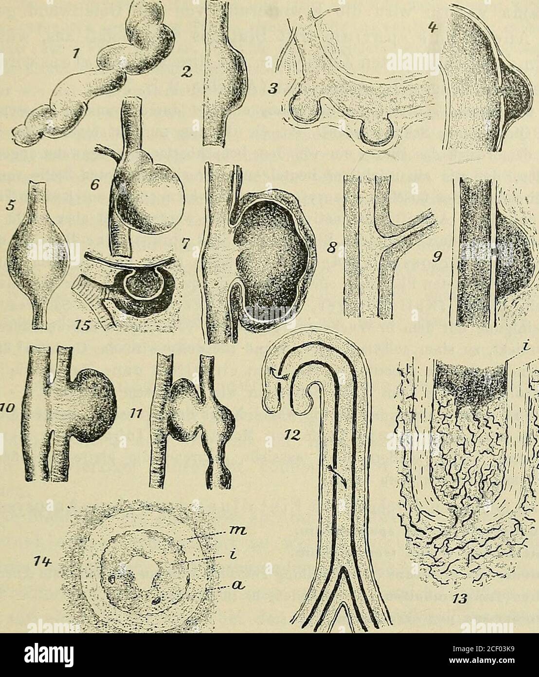 . Lehrbuch der speziellen pathologischen Anatomie für Studierende und Ärzte. inForm diskreter Knötchen oder diffus, und dann verkäsen. Bersten verkästeGefäße, so folgen Blutungen. Häufig ist das im Beginne der Lungenschwindsucht der Fall, während die Blutungenin späteren Stadien dieser Erkrankung meist von geborstenen Aneurysmen in Ca-vernen — Abbildung 15 S. 77 — herrühren (vergl. bei Lunge). — Bei der tuber-kulösen Meningitis ist besonders typisch eine länglichrunde Anschwellungder Gefäße durch Tuberkel, die von der adventitiellen Scheide ausgehen. DieIntima kann dabei dicht von Rundzellen i Stock Photo