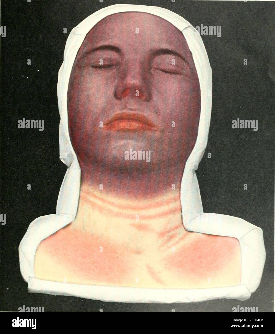 . Atlas of clinical surgery; with special reference to diagnosis and treatment for practitioners and students. in criminal and accident cases in whichthere is no visible lesion of the abdomen. The sud-den appearance of this extensive hemorrhage in thehead and neck causes a dark-blue coloration of theskin, protrusion of the eyes, and a swollen andbloated appearance of the skin and mucous mem-branes. It occurs in cases of crush, run-over cases,and compression by machinery, and is due to backpressure on the valveless veins of the neck from com-pression of the thorax and abdomen, with rupture ofth Stock Photo