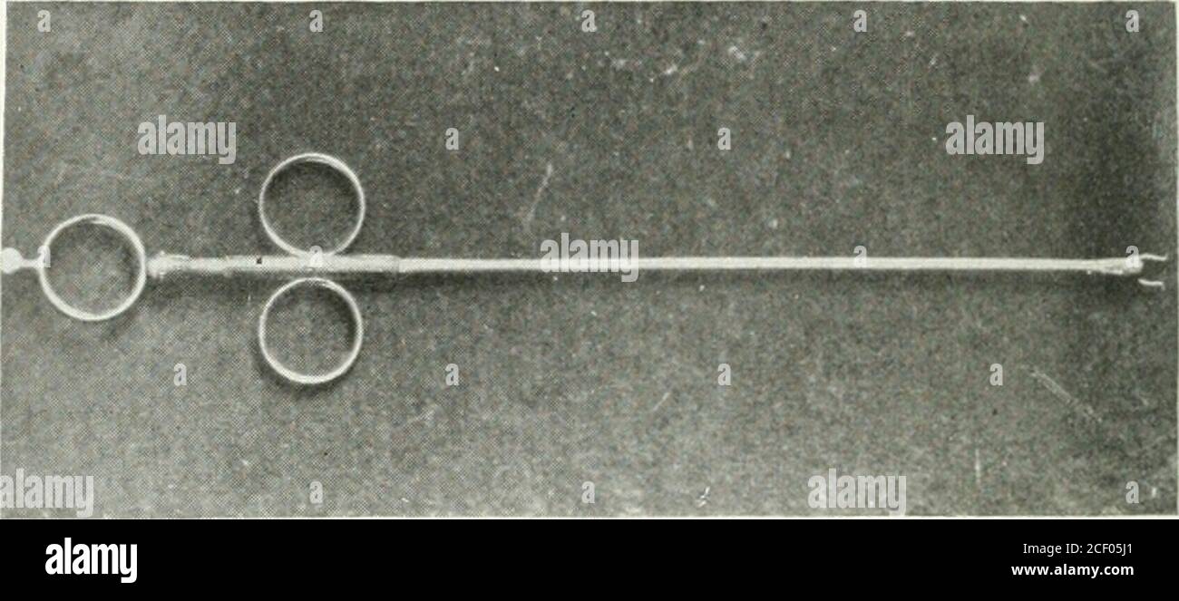 . Annals of surgery. Modified Wells bullet forceps in telephonic circuit, grasping the foreign body. Fig. 3.. Modified Wells bullet forceps, prongs partly open. Fig. 4. Lead pencil cap removed from bronchus. FOREIGN BODIES IN A BRONCHUS. 773 well, he again applied for admission to the hospital three and ahalf years later (October 3, 1895, Hospital Case No. 6281) withthe same story of having swallowed the tube. On this occa-sion, however, he was awake when the accident occurred, and wasstooping over washing his face when he felt the tube detachitself from the cannula. There was a momentary sens Stock Photo