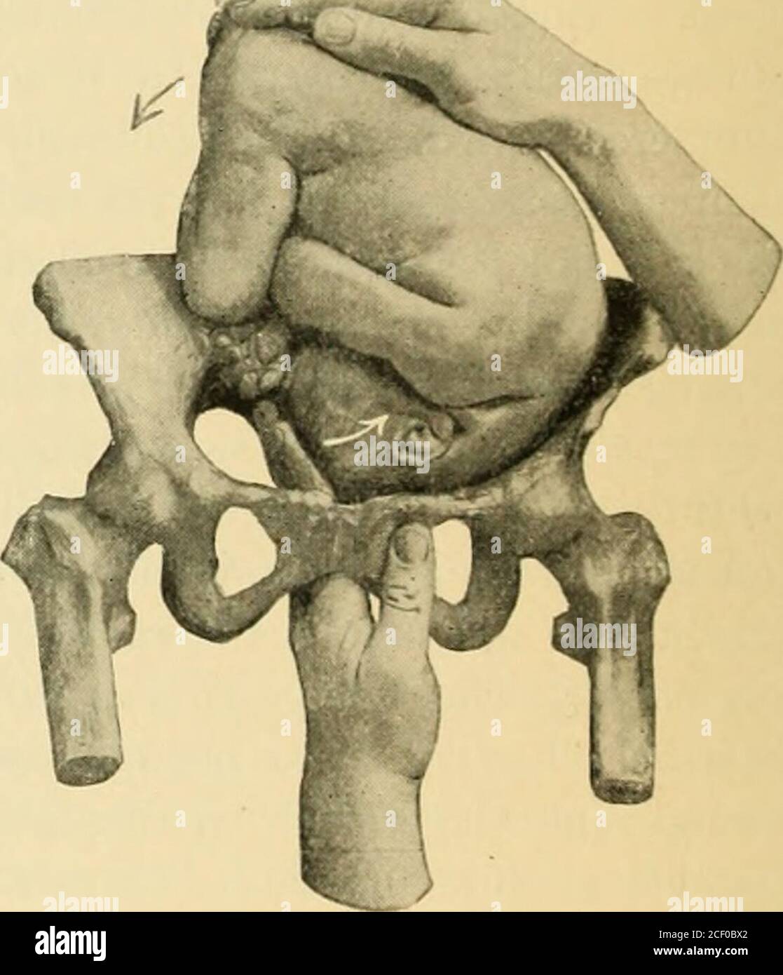 . An American text-book of obstetrics. For practitioners and students. ective andthe most commonly employed, as wellas the most dangerous, the hand ispassed into the uterus deeply enoughto seize one or both feet and to bringthem through the cervix. The indications are those already described onpage 942, and the same may be said of the contra-iudications, with emphasison the fact that the reasons there given apply with their fullest vigor to thismethod, which in neglected cases may constitute a difficult and hazardousoperation. The conditions necessary for the performance of internal podalic ve Stock Photo