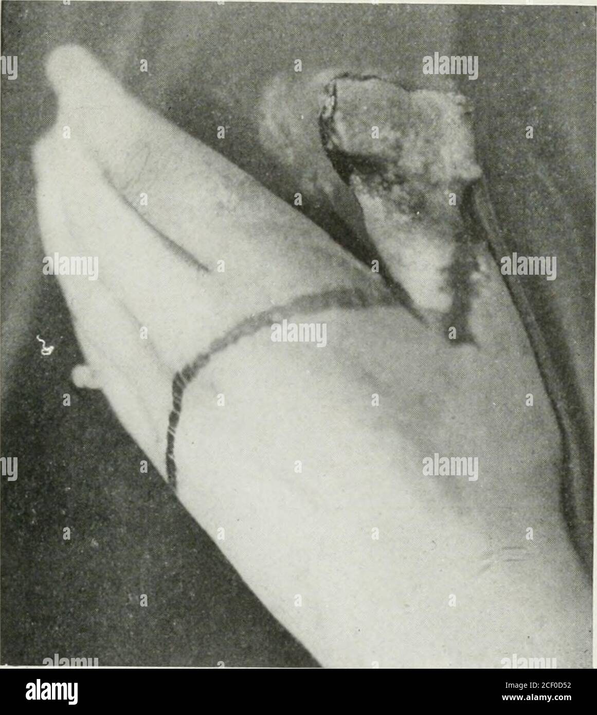 Lateral curvature of the spine and round shoulders . will sometimesshow a  slight tendency to curve to the right in the dorsal region, which  FUNCTIONAL SCOLIOSIS. SI may be due to