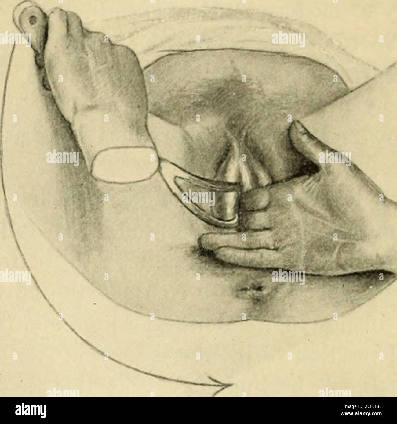 . An American text-book of obstetrics. For practitioners and students. rs. Some operatorsprefer placing the patient in the lithotomy position, the knees being supportedand steadied by a couple of assistants. The operator sits in front of the patient,between the everted thighs. The lower blade of the forceps is passed first intothe left side of the pelvis, then the upper blade is passed into the right side;when properly adjusted, the blades are locked and extraction is begun. Tointroduce a forceps-blade properly both hands are used, one to pass the blade,the other to guide it up to and around t Stock Photo