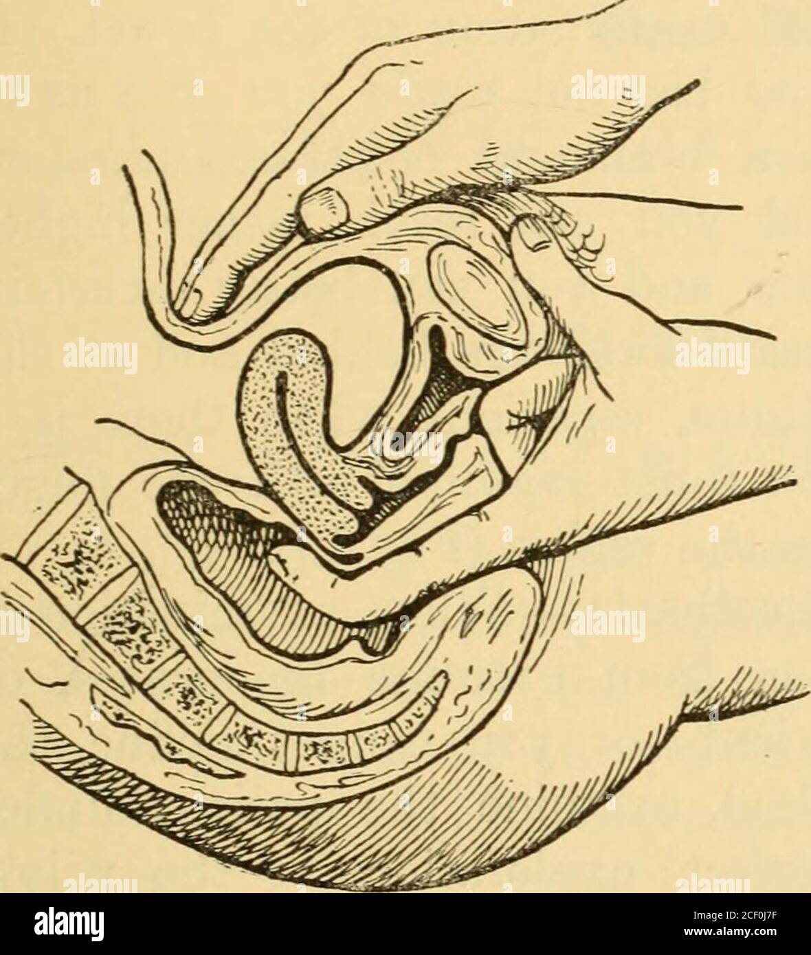  Diseases Of Women A Clinical Guide To Their Diagnosis And Treatment Fig 9 Volsella Fig 
