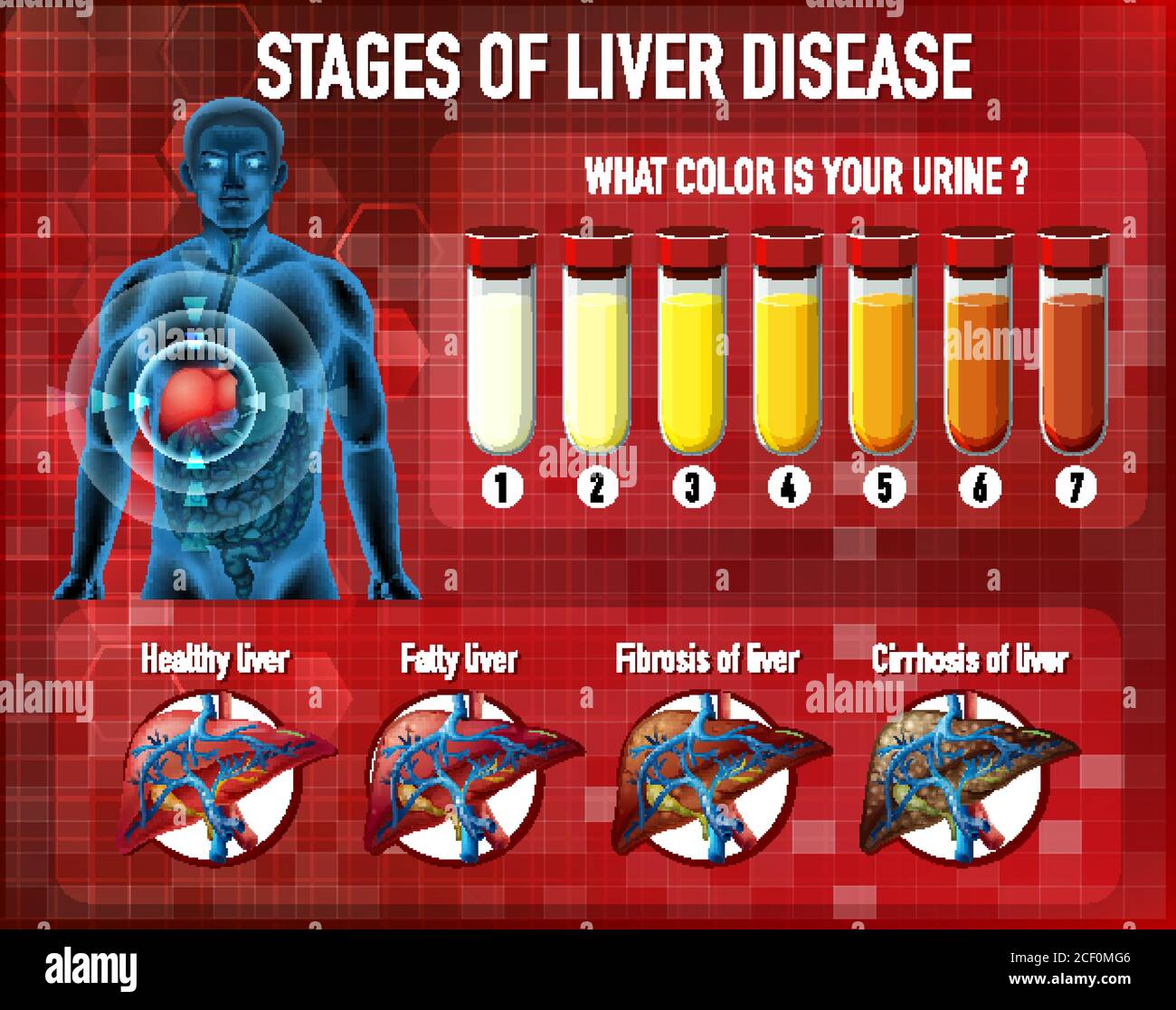 Stages of liver disease illustration Stock Vector Image & Art Alamy