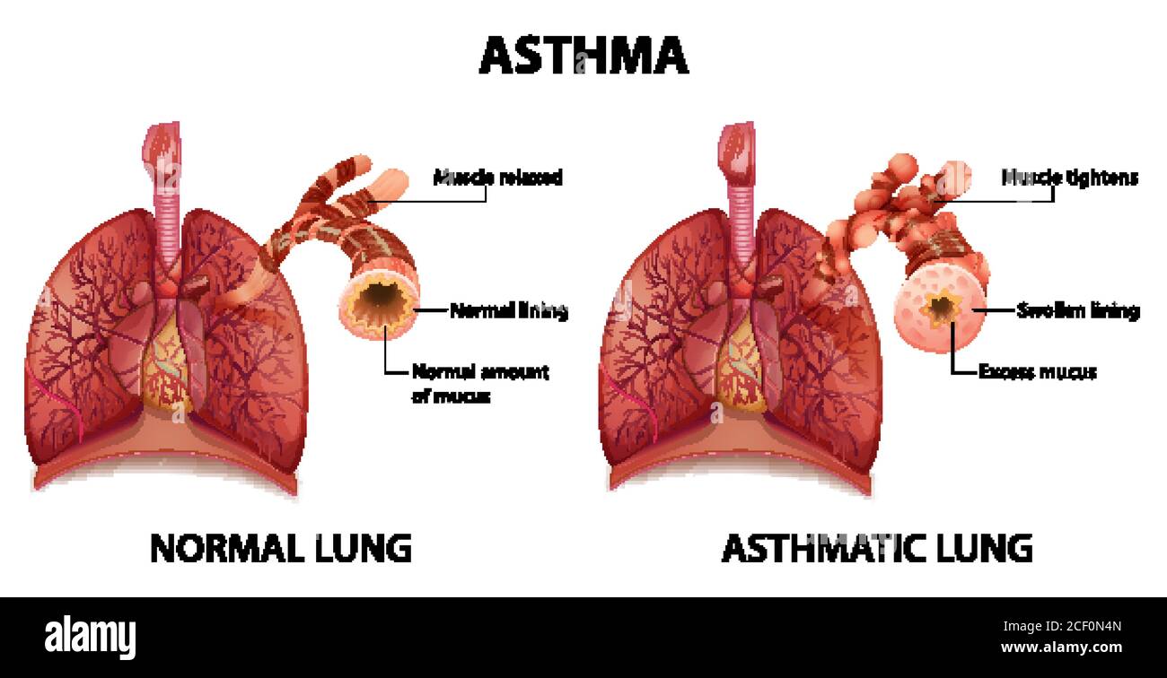 Comparison of healthy lung and Asthmatic lung illustration Stock Vector ...