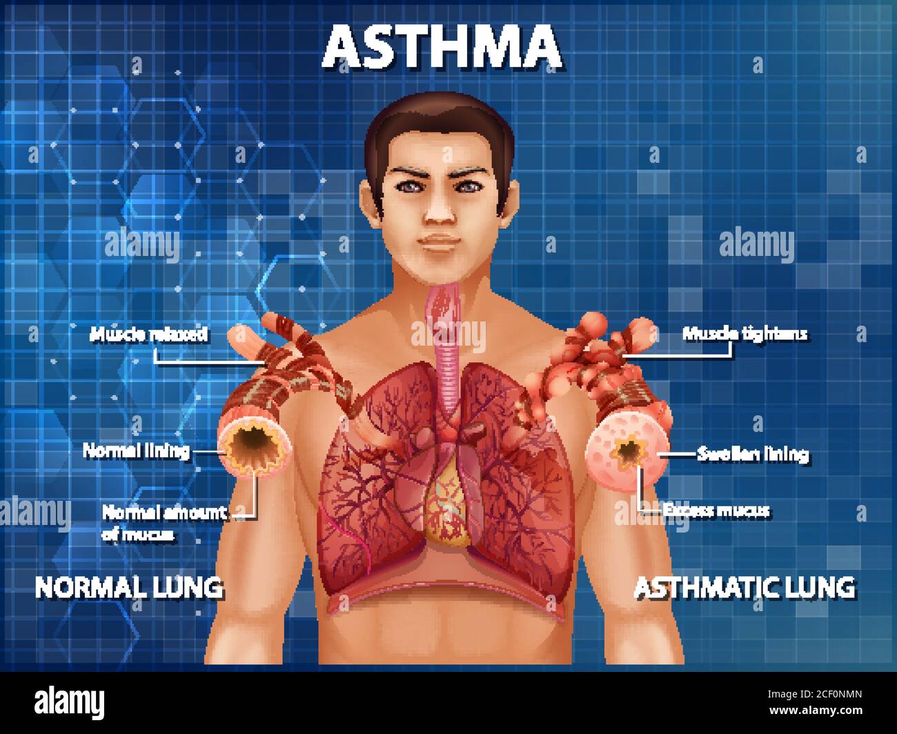Human anatomy Asthma diagram illustration Stock Vector