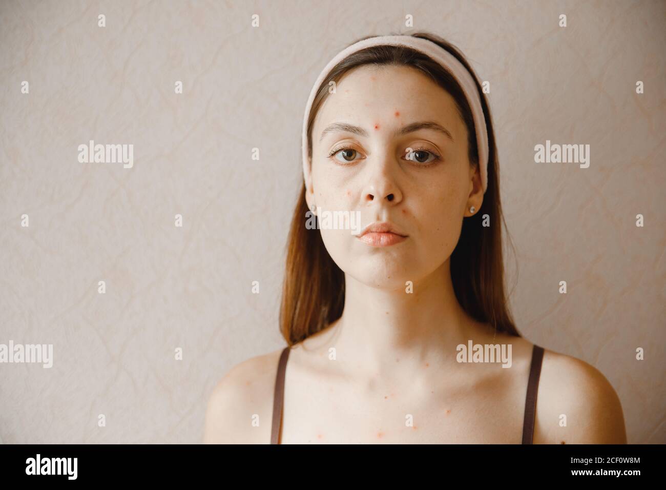 Skin young woman is affected by chickenpox acne defects Stock Photo