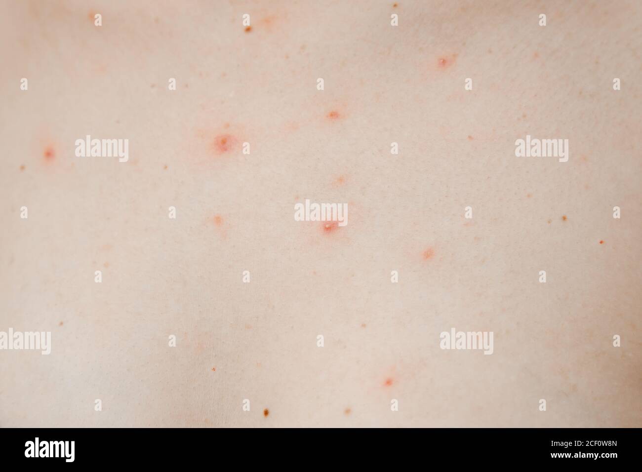 Chicken pox hi-res stock photography and images - Alamy