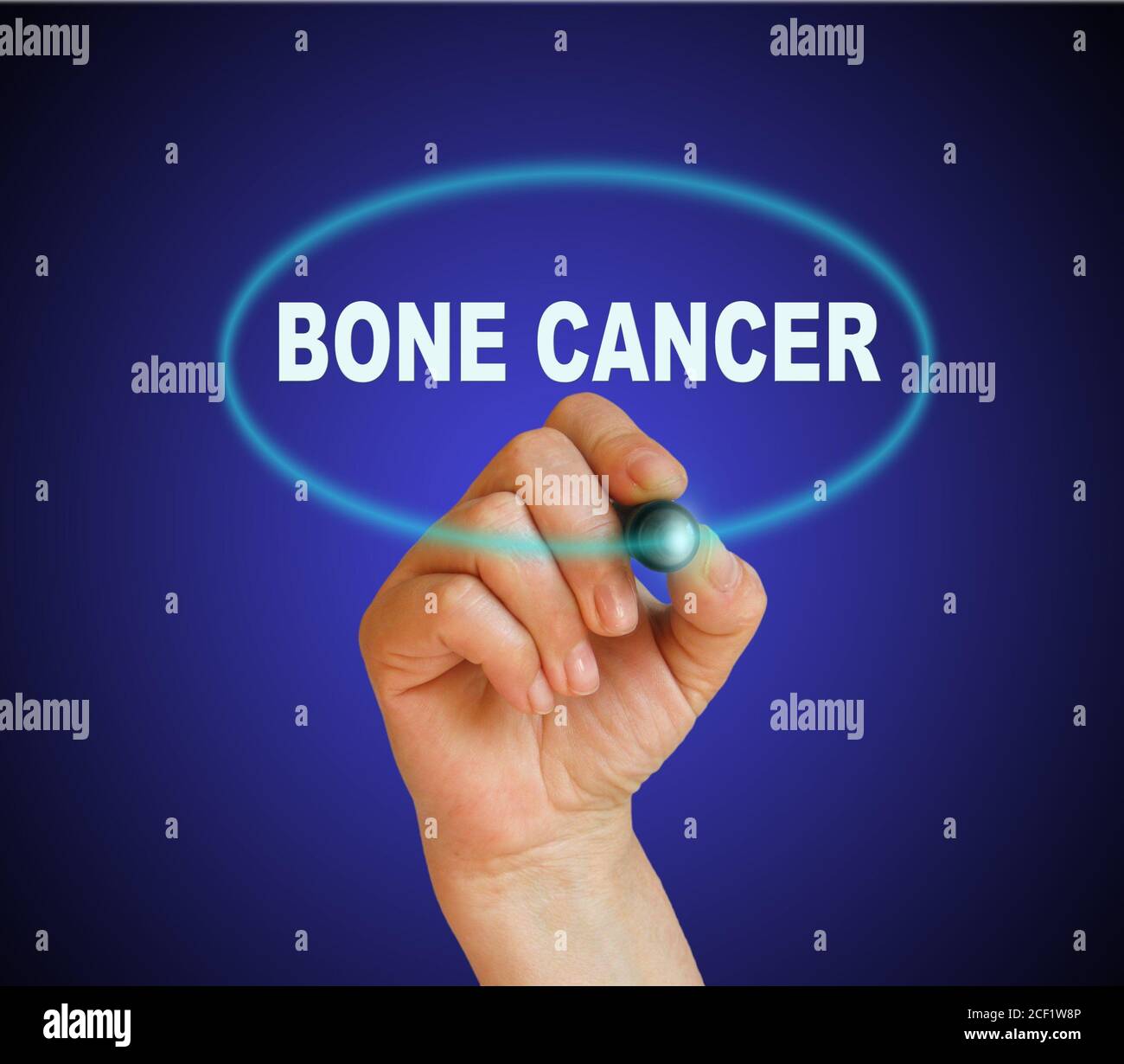 Writing Word BONE CANCER On Gradient Background Made In 2d Software Stock Photo Alamy