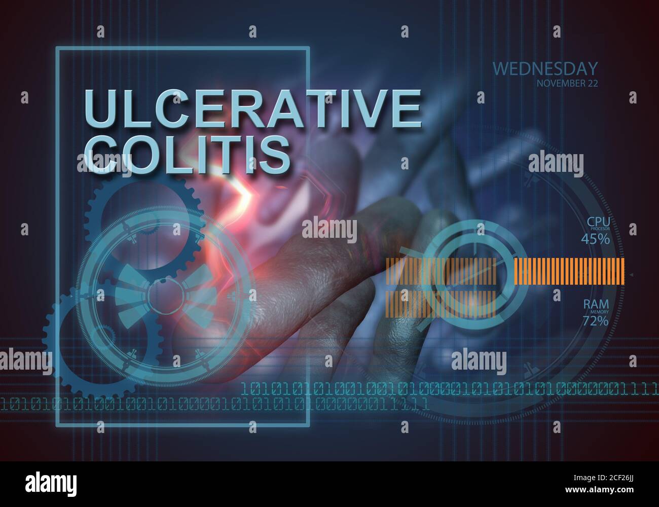hi tech infographics of ulcerative colitis made in 3d software. Stock Photo