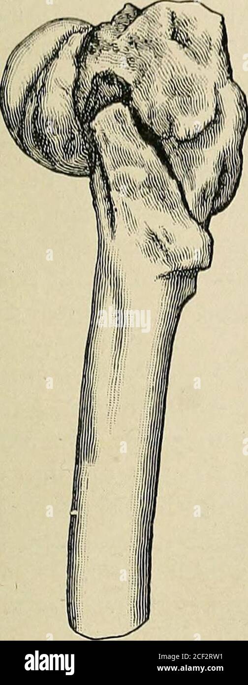 . A practical treatise on fractures and dislocations. ond by a tourniquet; it couldbe increased and diminished at will and was borne without discomfort.In both cases the fracture was thought to be through the neck (intra-capsular), and the patients were young men. They mark an important 1 Hennequin : Fractures des os longs, 1904. 2 Shaffer: New York Medical Journal, October 23, 1897, p. 557. FRACTURES OF THE FEMUR. 343 advance in the treatment of failure of union and suggest the more gen-eral use of trochanteric pressure, especially in fractures through the necl,Encasement of the limb and pelv Stock Photo