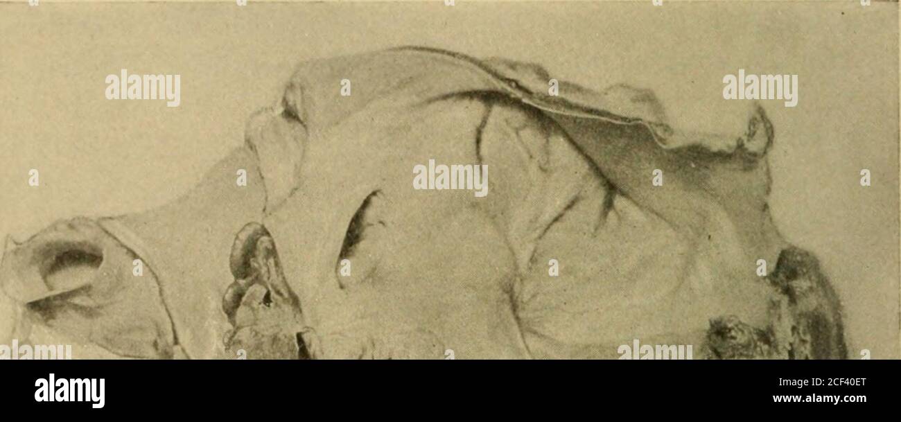 . Diseases of the heart and arterial system; Designed to be a practical presentation of the subject for the use of students and practitioners of medicine. Fig. 24.—Verrucose Endocarditis of Aortic and Mitral Valves.Specimen in collection of Dr. Gustav Fiitterer. on the free margins of the valve-cusps, but along a line correspond-ing to the point of maximum contact when the valves close (Fig.24). In the case of the auriculo-ventricular valves this is on theauricular surface, while on the semilunar A^alves it is on the ven-tricular surface. From these facts it is evident that the work thatthe va Stock Photo