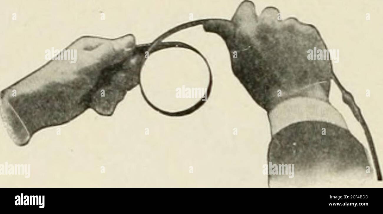 . Abdominal hernia its diagnosis and treatment. 3Shaping truss