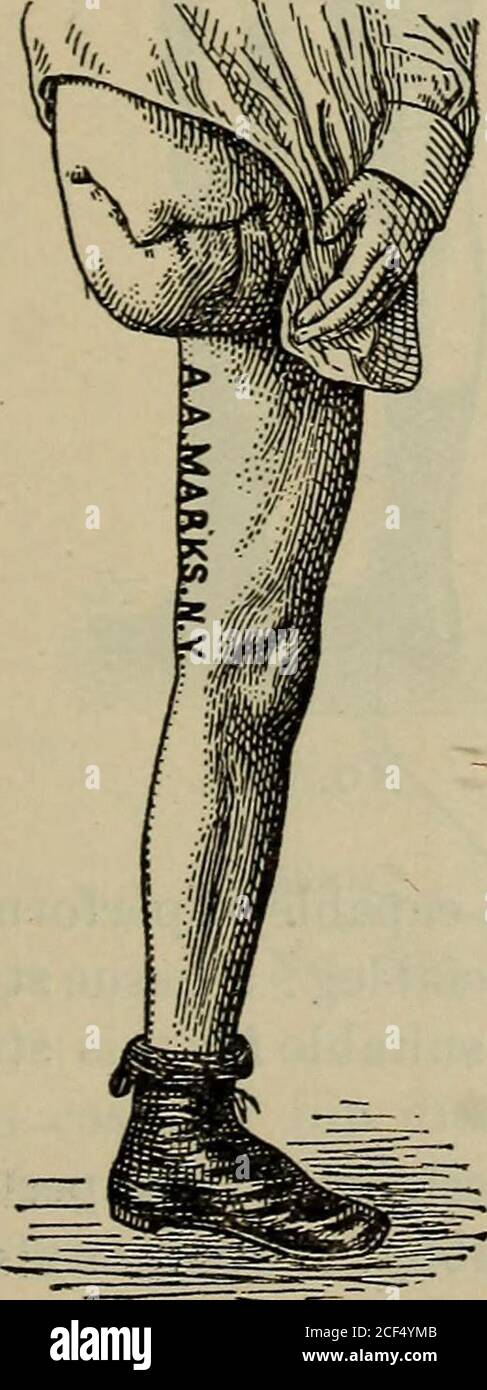 . A treatise on artificial limbs with rubber hands and feet ... No. 538. No. 539. No. 537, a similar stump, but a trifle longer. A. A. MARKS, ARTIFICIAL LIMHS, NEW YORK CITY. 49 No. 538, a long and large thigh stump with abundance of tissue onthe extremity, capable of bearing pressure upon the extremity. No. 539, a thigh stump extending nearly to the knee, the extremityconical and tender.. No. 540. Stock Photo