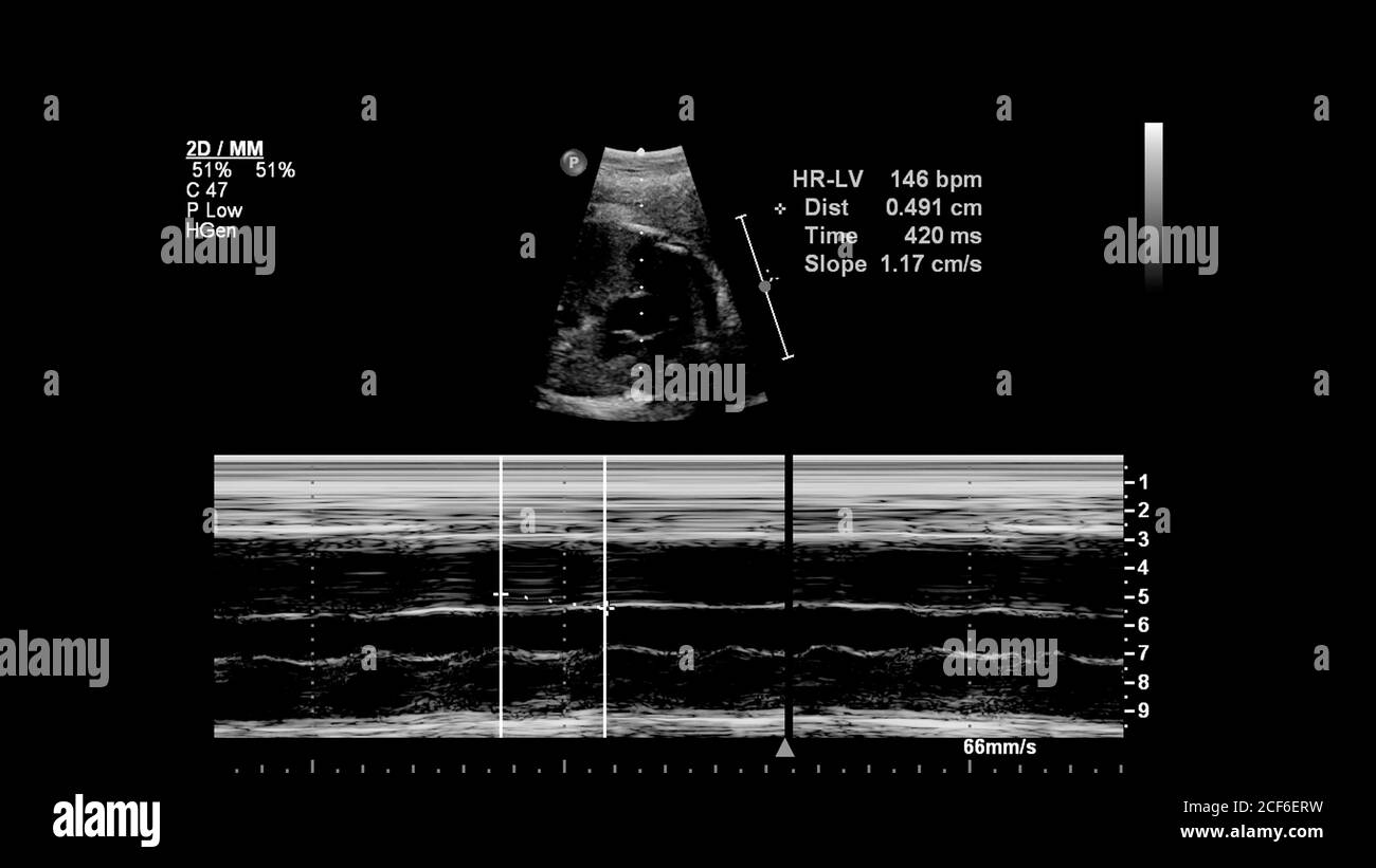 Ultrasound screen with fetal echocardiography Stock Photo - Alamy