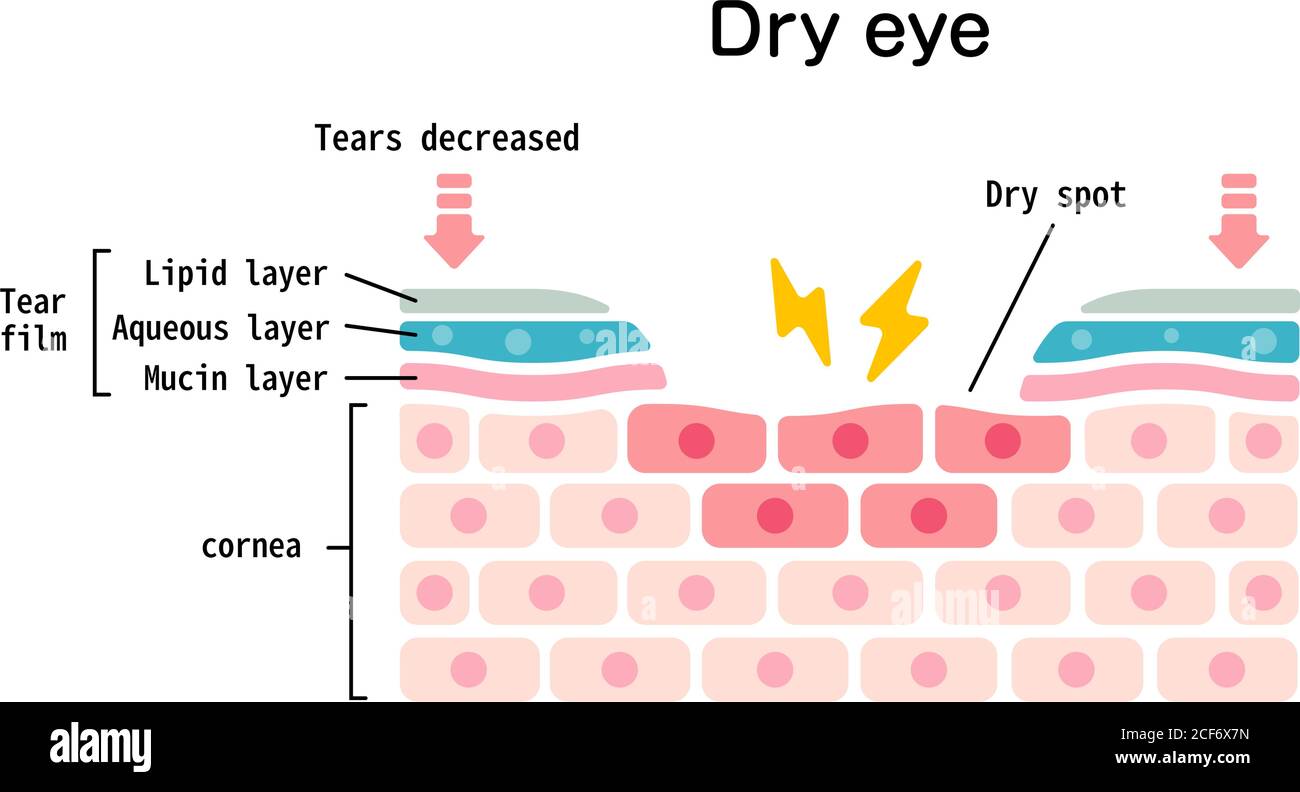 Cross section of dry eye surface. flat vector illustration Stock Vector