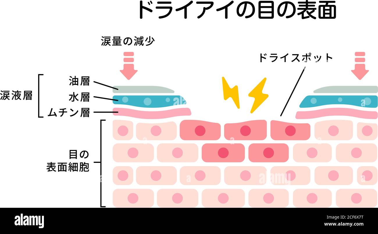 Cross section of dry eye surface. flat vector illustration (Japanese) Stock Vector