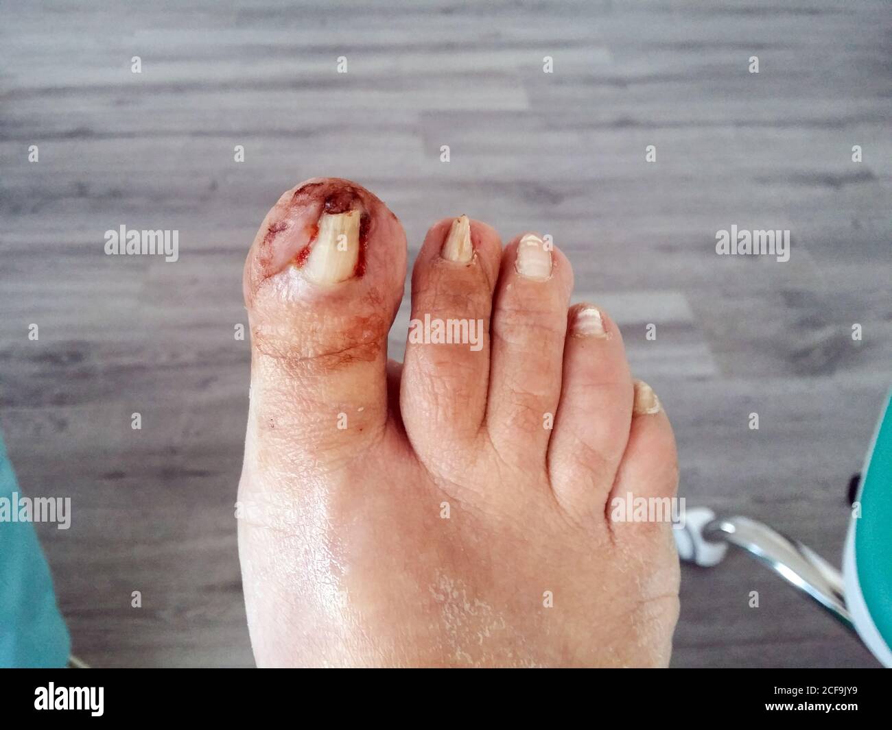 Crop feet of patient with bloody nail on big toe before operation in modern hospital Stock Photo