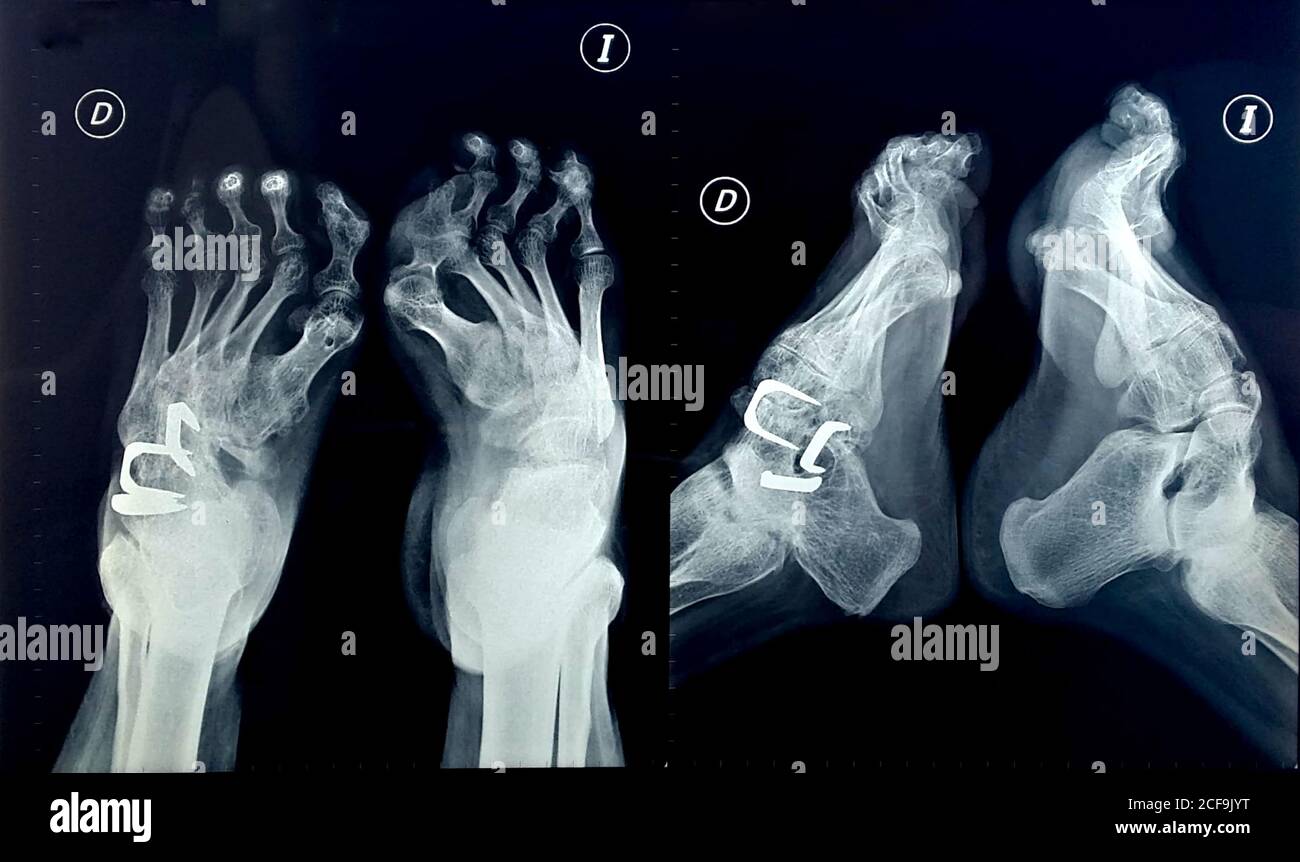 Deformed feet hires stock photography and images Alamy