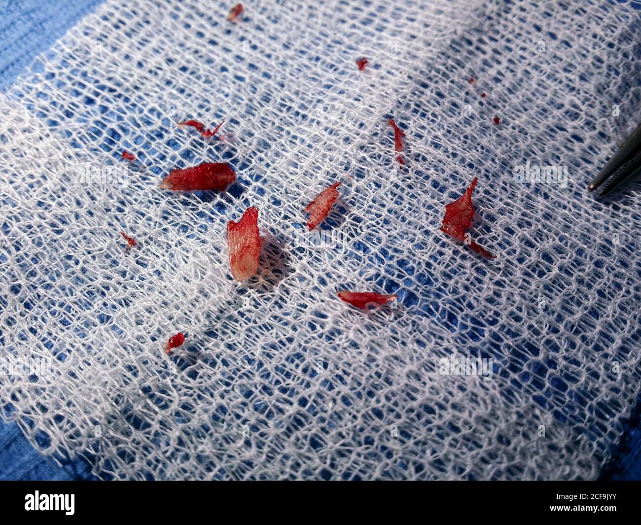 Closeup of bloody pieces of foreign body on white gauze after operation