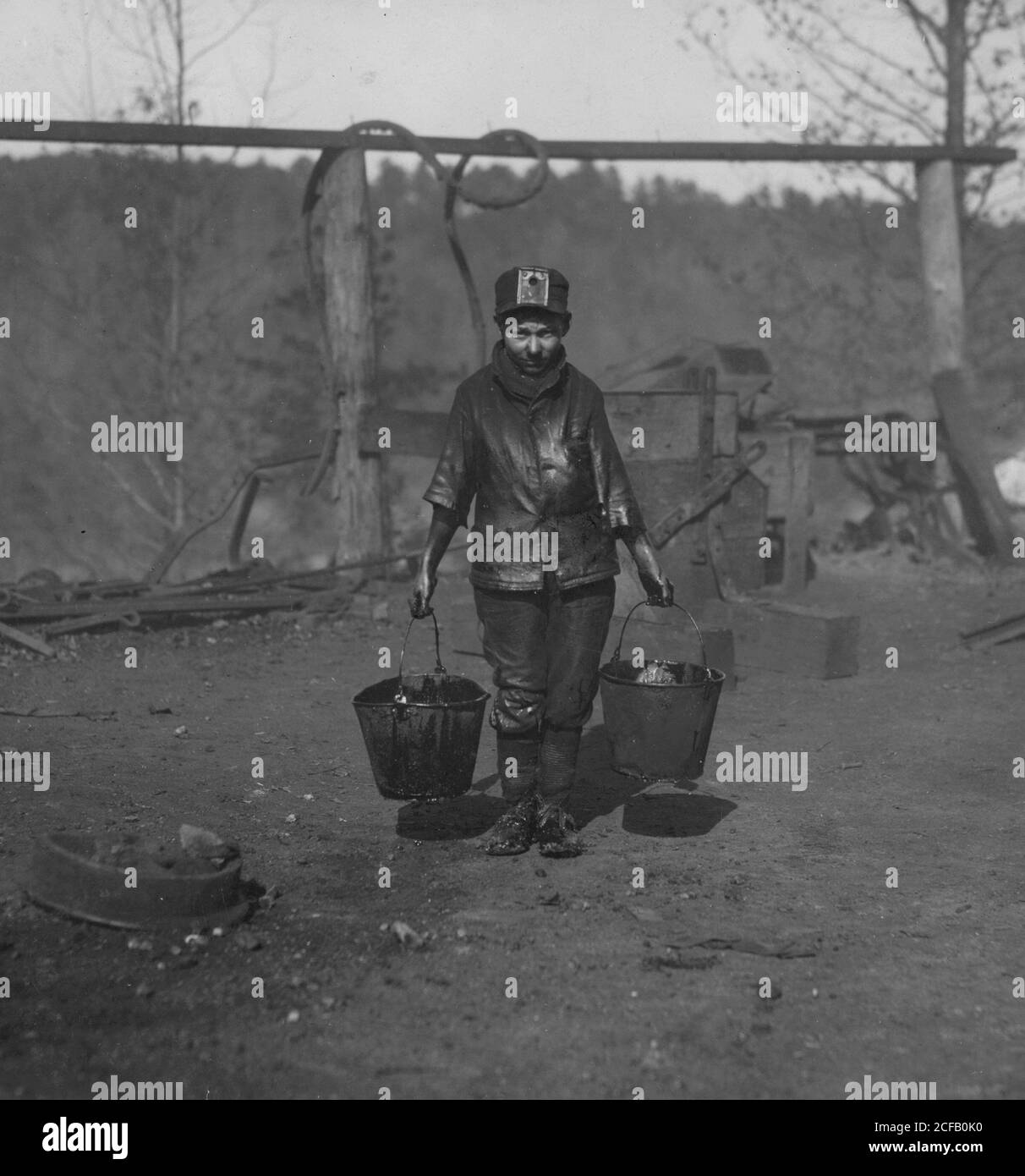 Boy with crushed leg works in the mines. Stock Photo