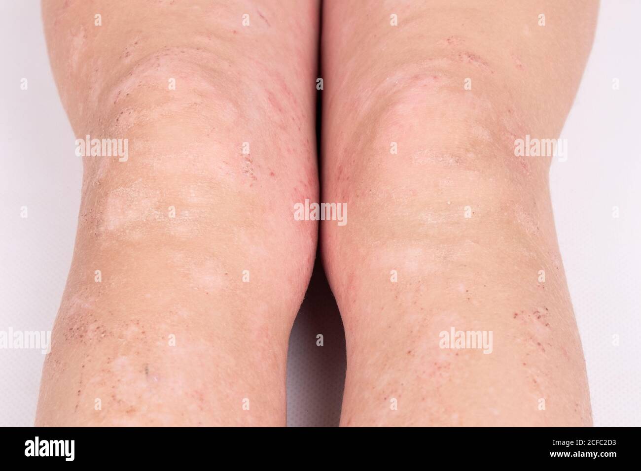rash on children's legs close-up, redness of the skin, allergic reaction. Stock Photo