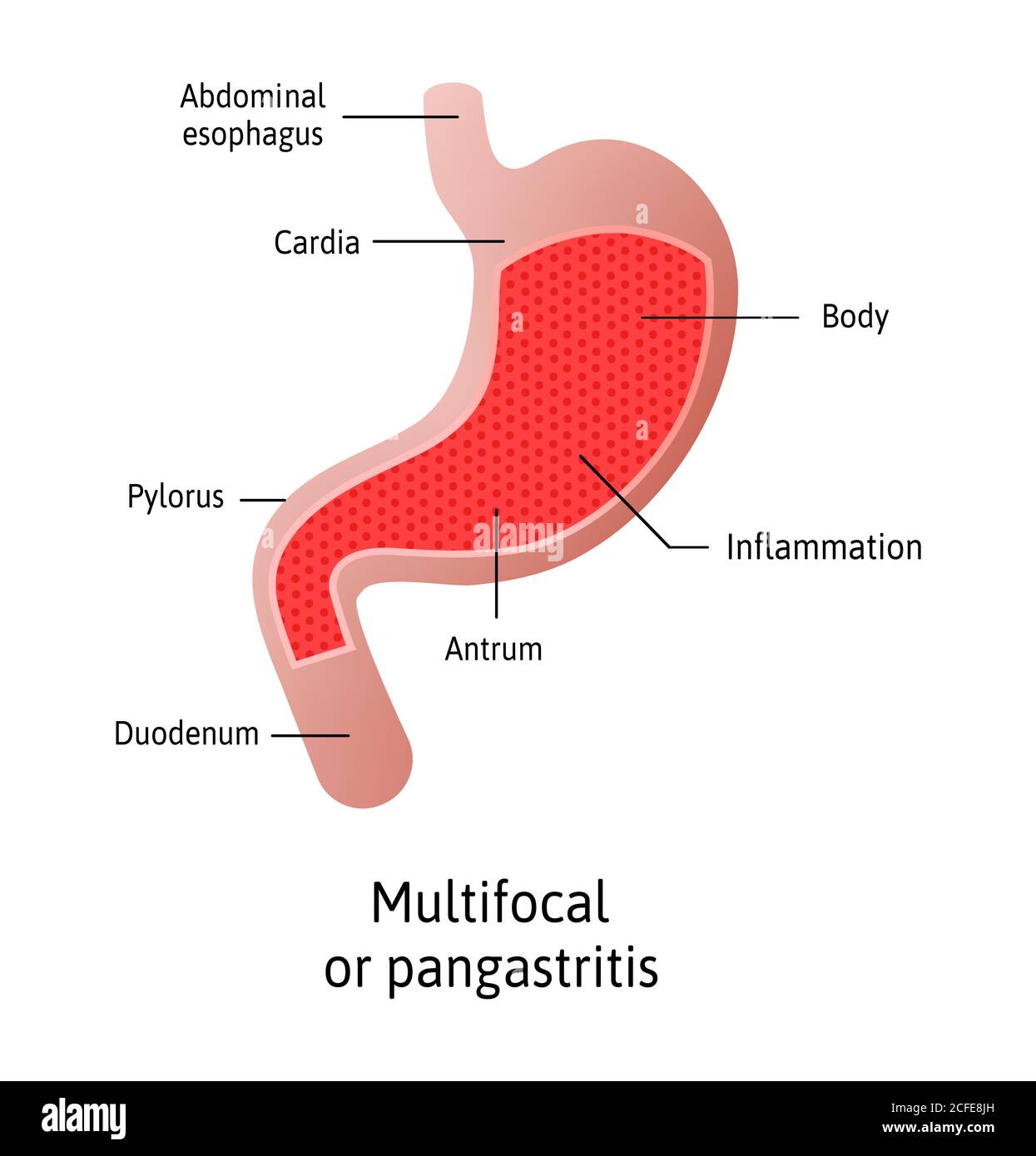 Location of Gastritis, multifocal, an inflammation of the lining of the stomach. Three types Antral, of the body and pangastritis. Medical vector Stock Vector