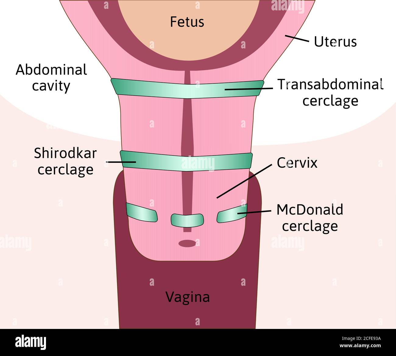three types of Cervical cerclage or cervical stitch, treatment for cervical weakness. Transabdominal, Shirodkar and McDonald cerclage. Fetus in womb Stock Vector