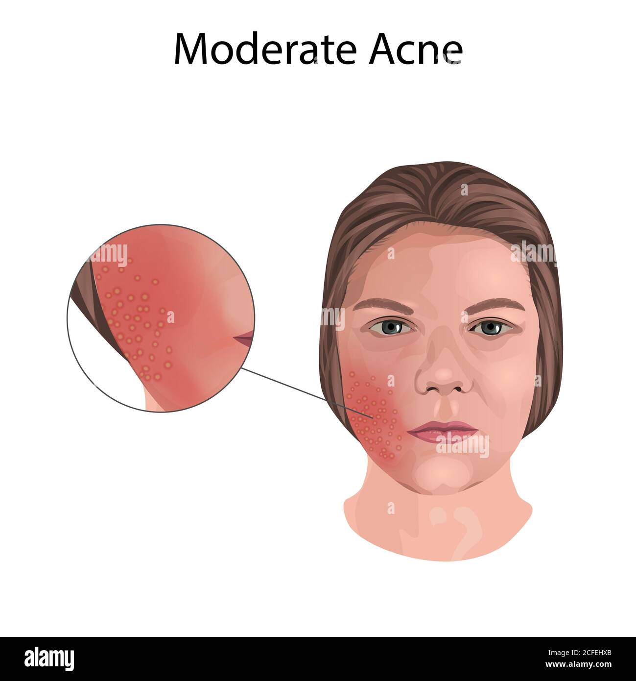 Moderate acne, illustration. Close-up view Stock Photo
