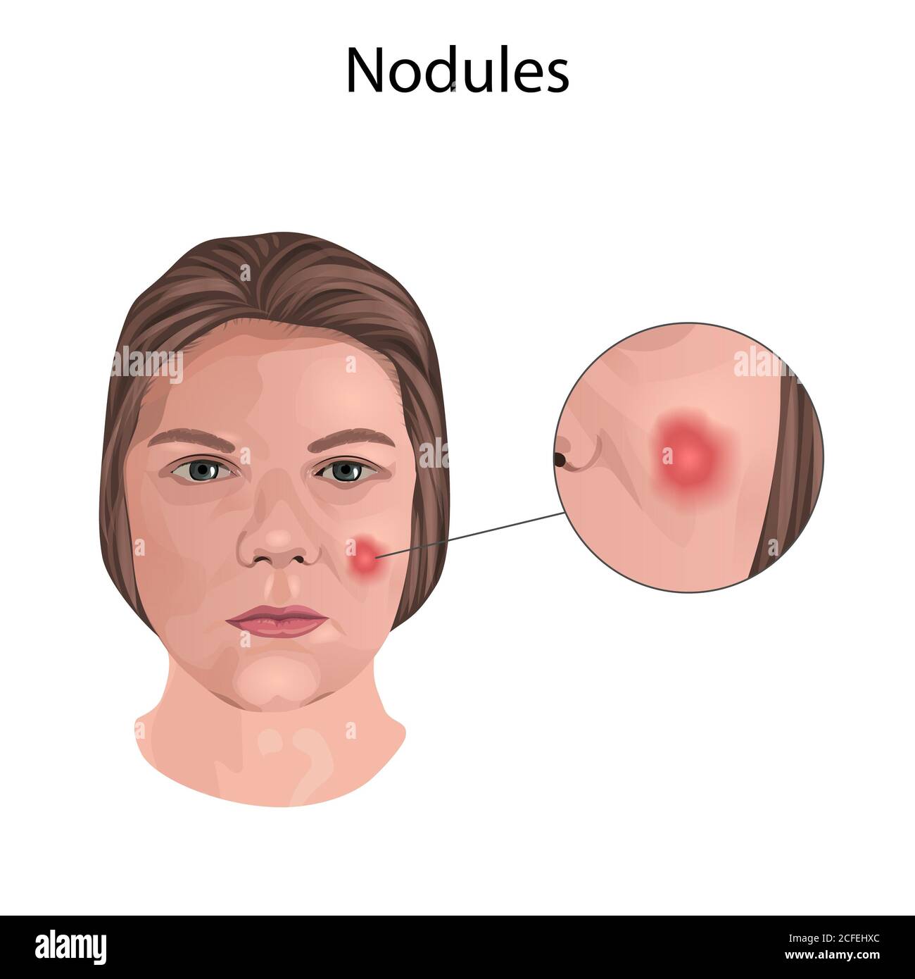 Nodules, illustration. Close-up view Stock Photo