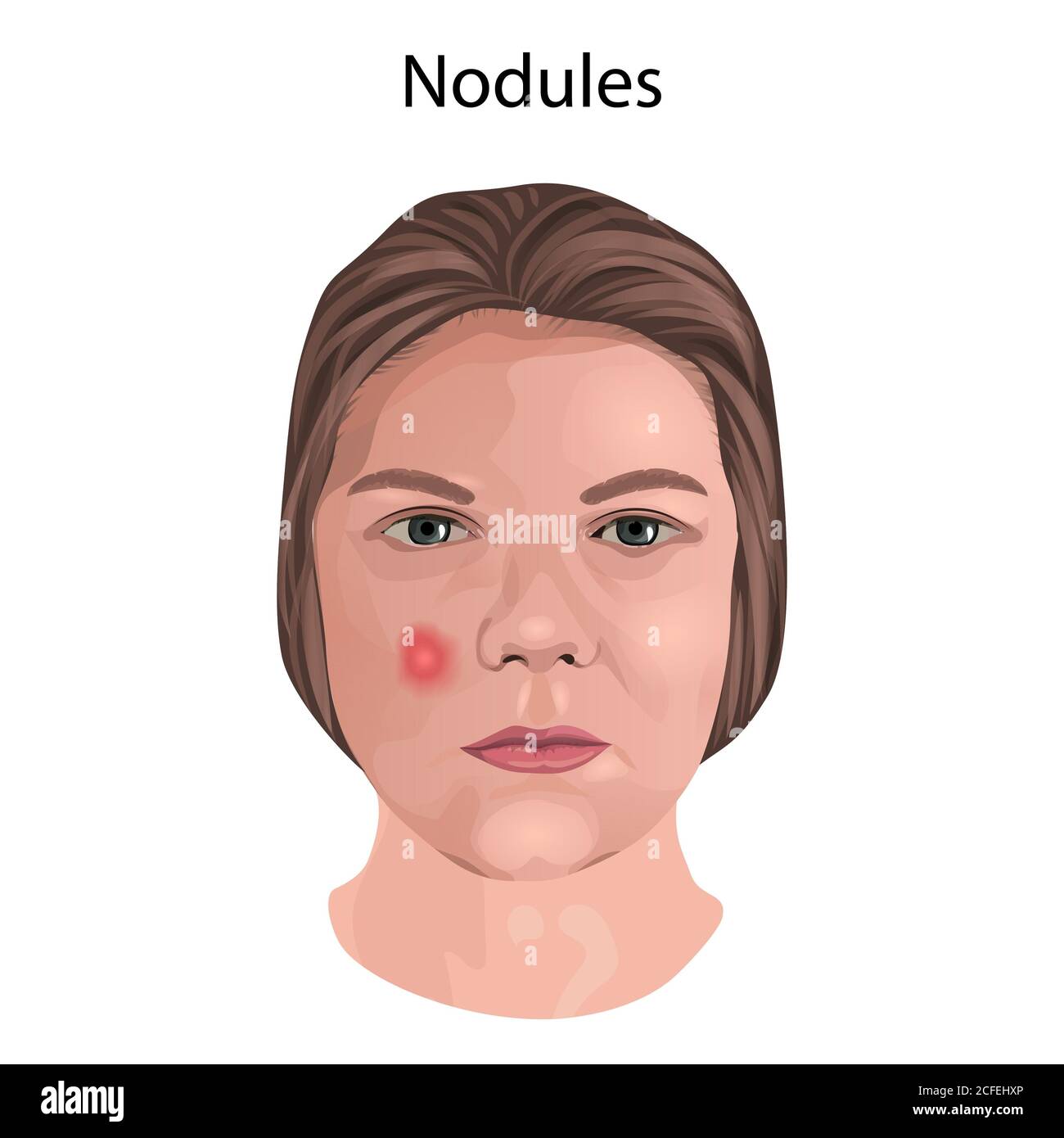 Nodules, illustration. Stock Photo