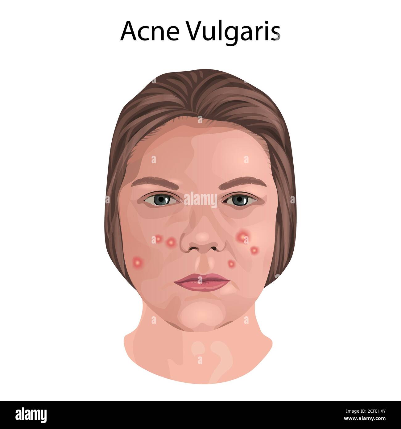 Acne Vulgaris Diagram
