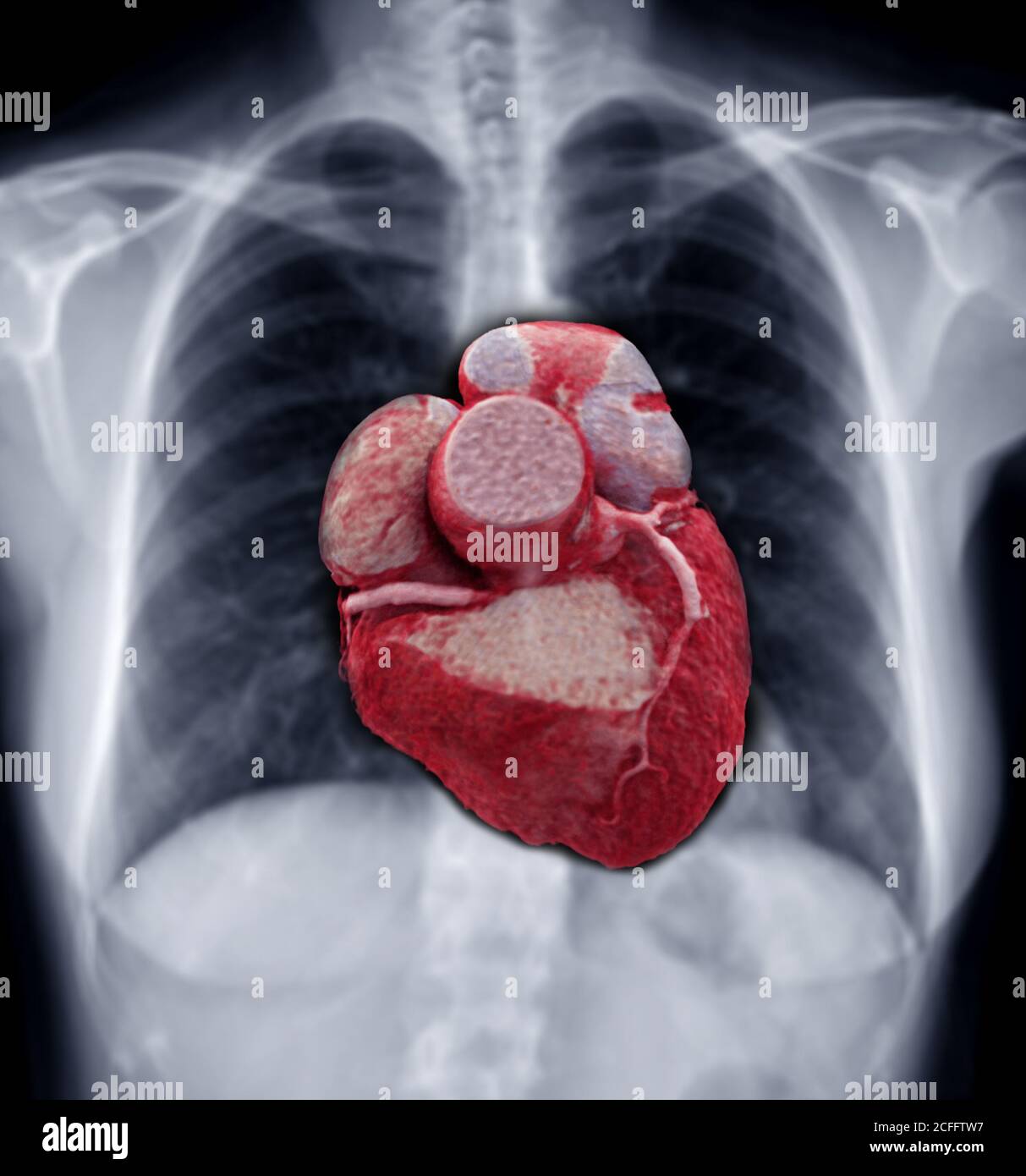 Fusion image of 3D CTA Coronary artery Image with blurred Chest Xray
